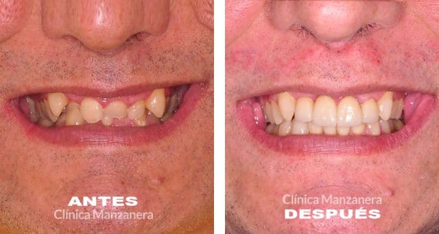 antes y despues caso odontología restauradora estética