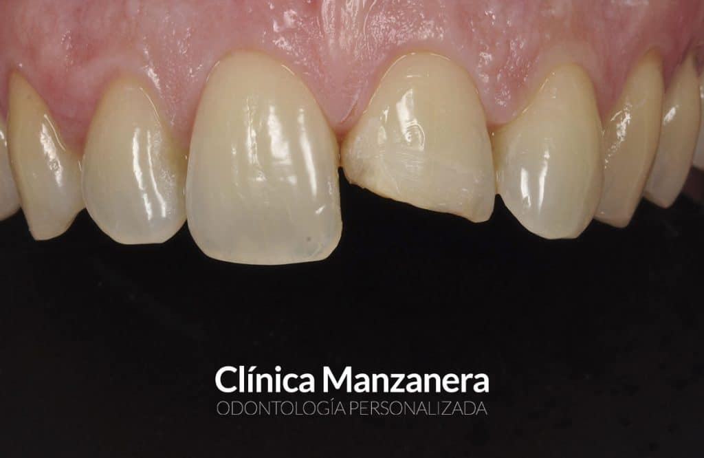 antes reconstruccion borde incisal