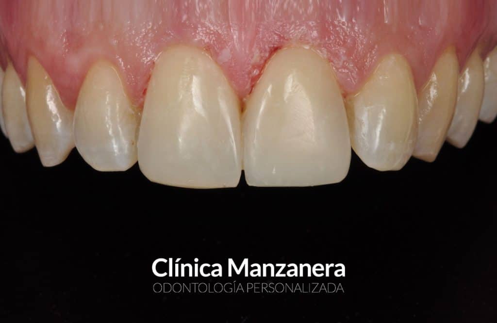 despues reconstruccion borde incisal