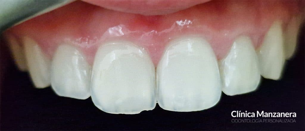 antes reconstrucción estética borde incisal fracturado