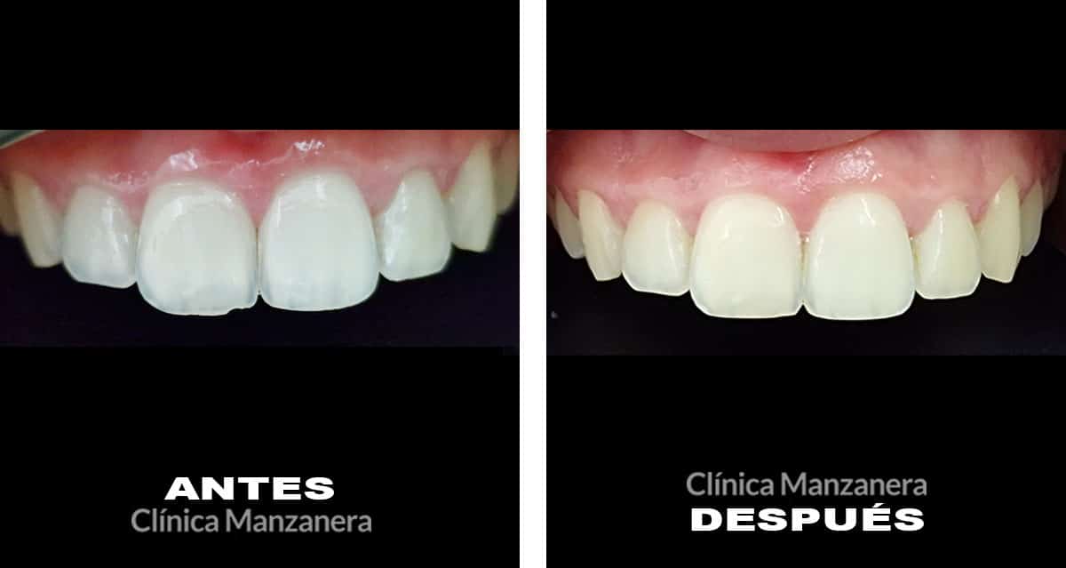 reconstrucción estética borde incisal fracturado