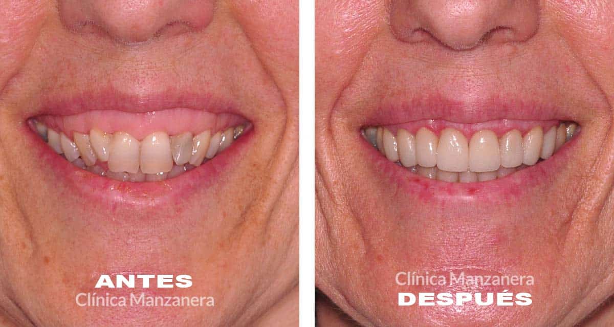 caso antes y después mordida anterior solucionado con ortodoncia invisible y carillas dentales de porcelana