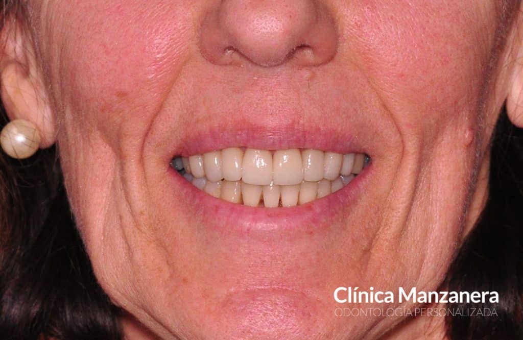 sonrisa final caso de apiñamiento y estrechez de arcada solucionado con ortodoncia invisible y carillas