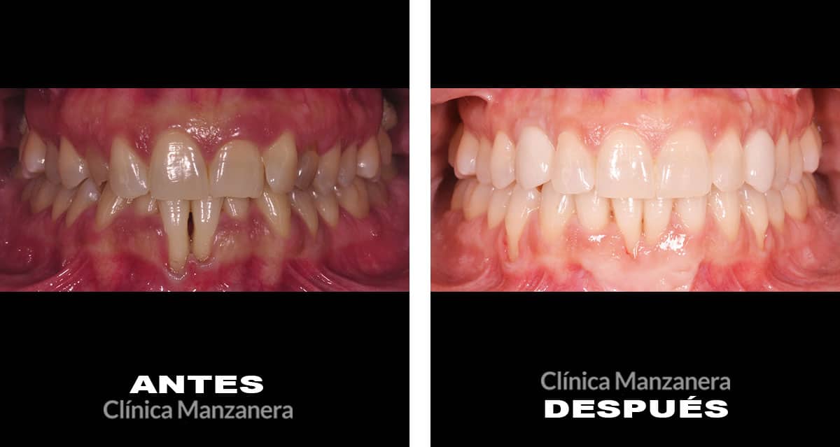 antes y después Ortodoncia invisible, canino incluido, injerto de encía, blanqueamiento e implantes