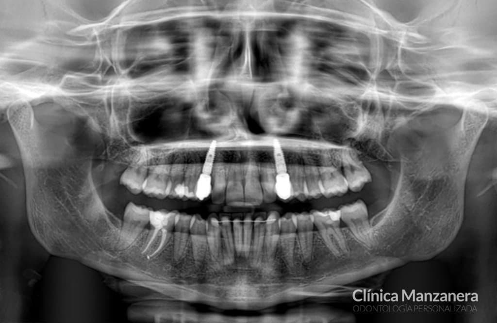 radiografía tratamiento