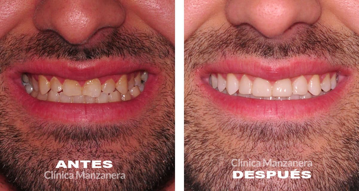 antes y después ortodoncia y composites inyectables