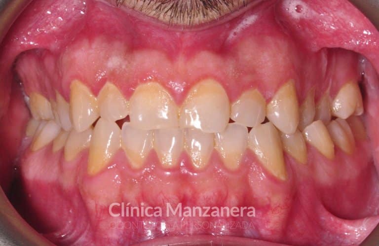 vista frontal caso composites inyectables