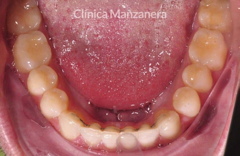 vista oclusal inferior caso composites inyectables despues