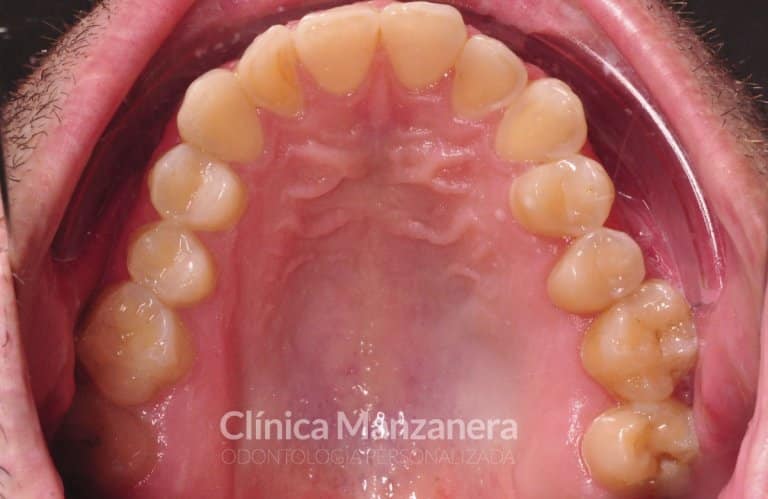 vista oclusal superior caso composites inyectables