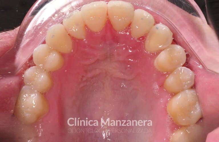 vista oclusal superior caso composites inyectables despues