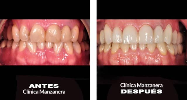 caso antes y después hombre invisalign y carillas porcelana