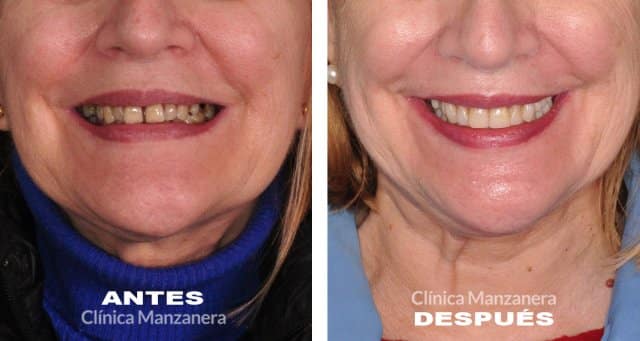 antes y después implantes dentales y carillas composite