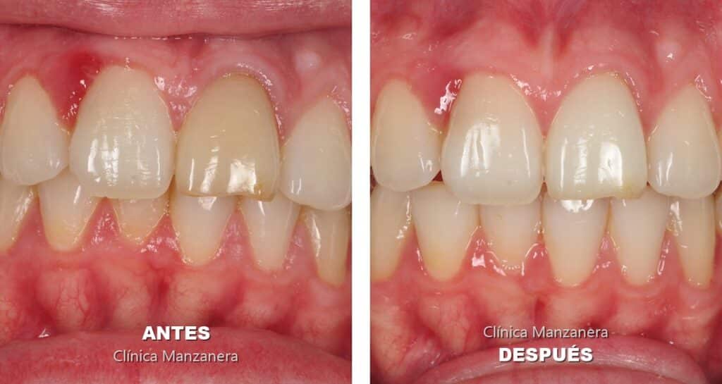 antes y después blanqueamiento interno de un incisivo oscurecido