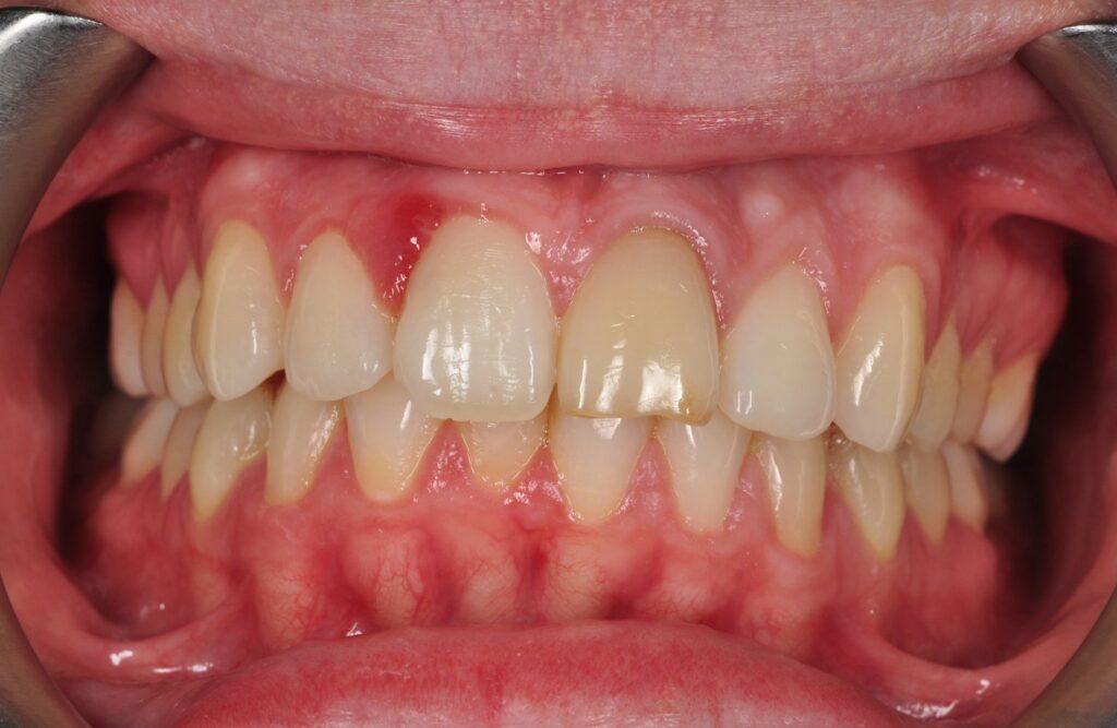 diente endodonciado oscurecido antes del blanqueamiento interno