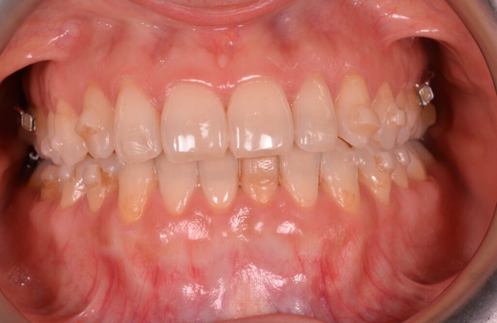 ortodoncia invisible con attachments durante el tratamiento