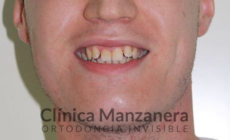 sobremordida, apiñamiento y desnivel gingival