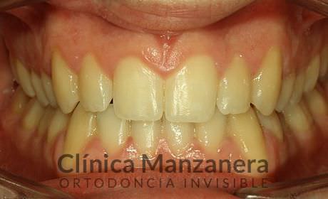 resuelto con Invisalign