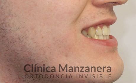 resuelto con Invisalign