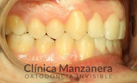 resuelto con Invisalign