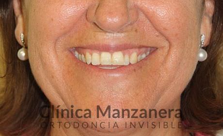 sobremordida, apiñamiento y desnivel gingival