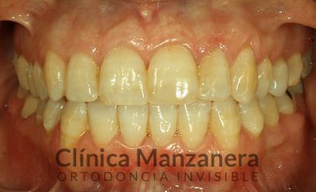 resuelto con Invisalign