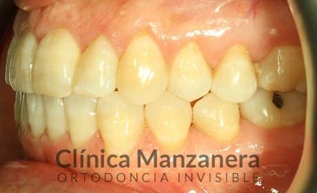 resuelto con Invisalign