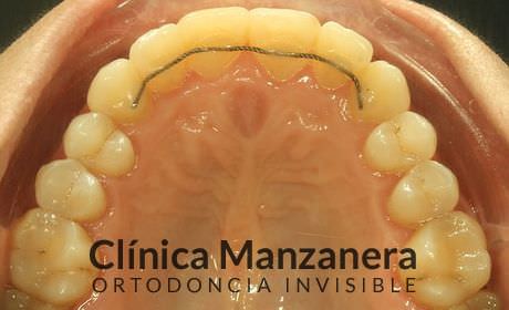 resuelto con Invisalign