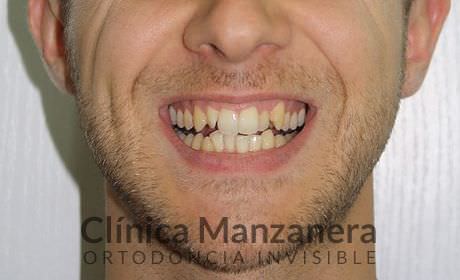 sobremordida, apiñamiento y desnivel gingival