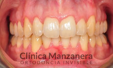 resuelto con Invisalign