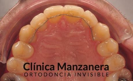 resuelto con Invisalign