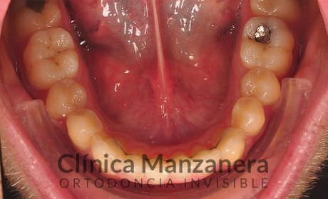 resuelto con Invisalign