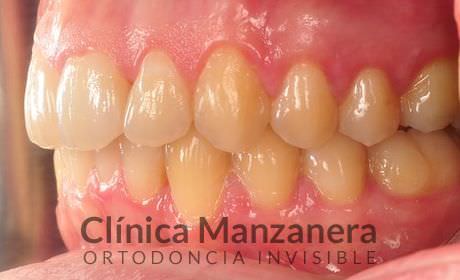 resuelto con Invisalign