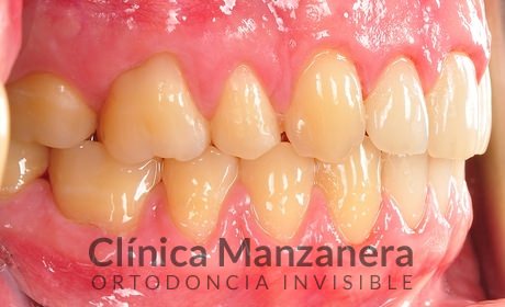 resuelto con Invisalign