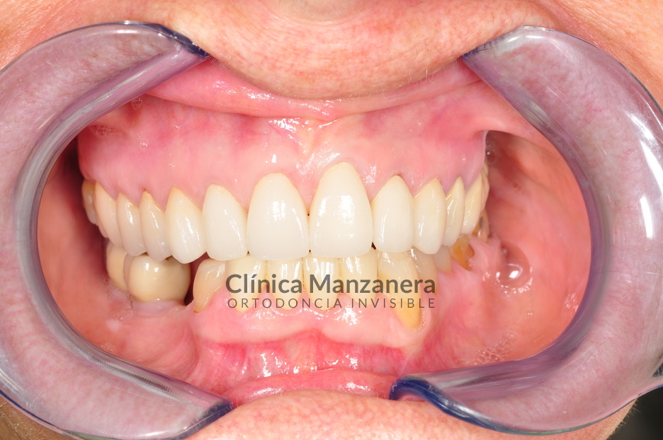 estetica dental coronas y carillas