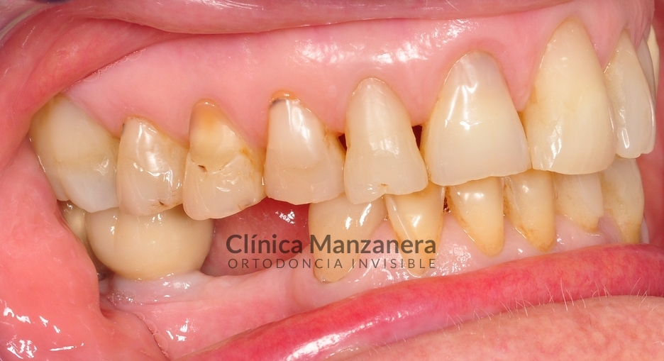 caso tratado estetica dental